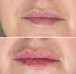 filler lips to correct assymetry 