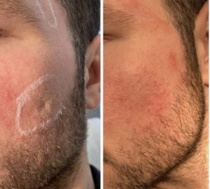 acne scar treatment with filler 