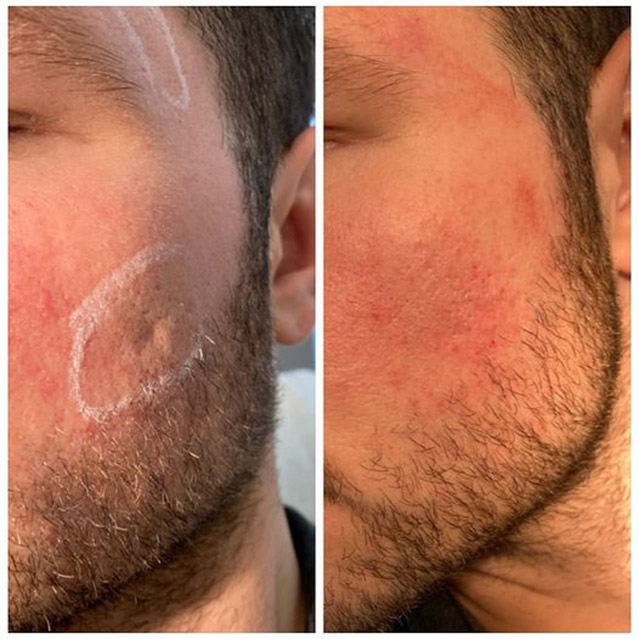 Image of a client before and after having treatment for acne