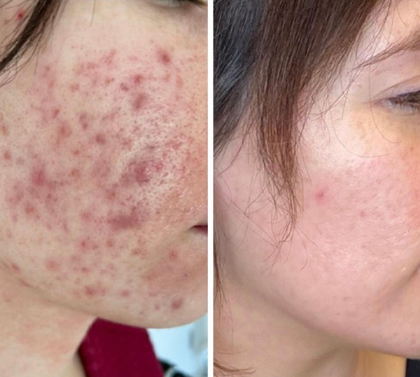 Image of a client before and after having treatment for acne