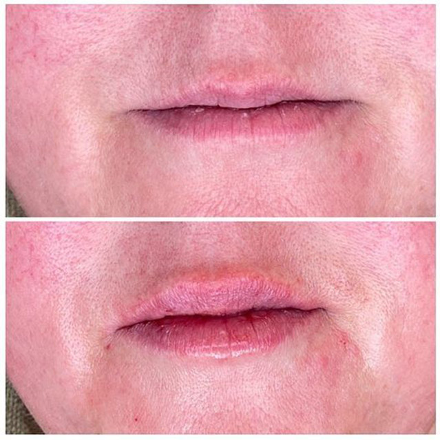 Image of a client before and after lip filler treatment.