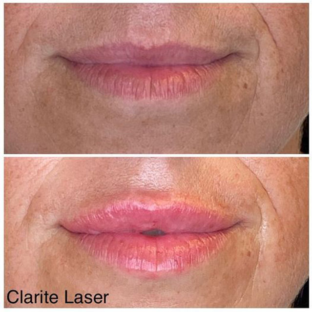 Image of a client before and after having lip filler treatment.