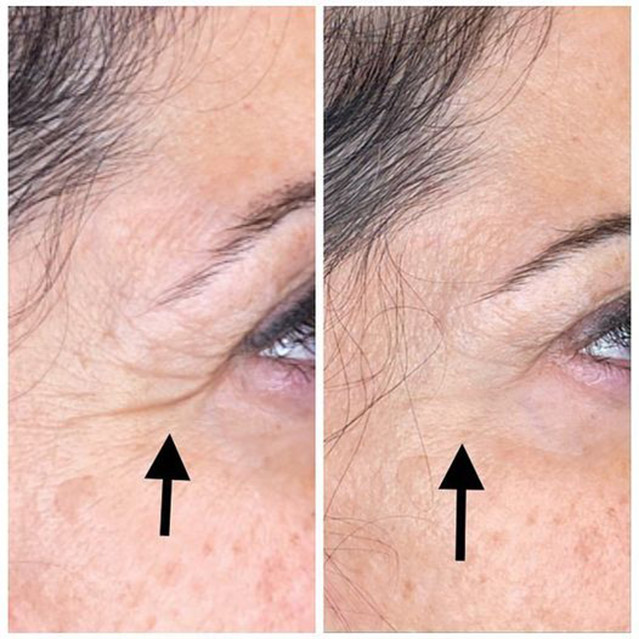 Image of a client before and after filler injection.