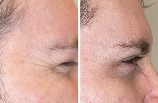 Image of a client before and after filler injection.