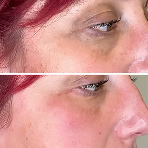 A photo of under eye filler work, before and after.