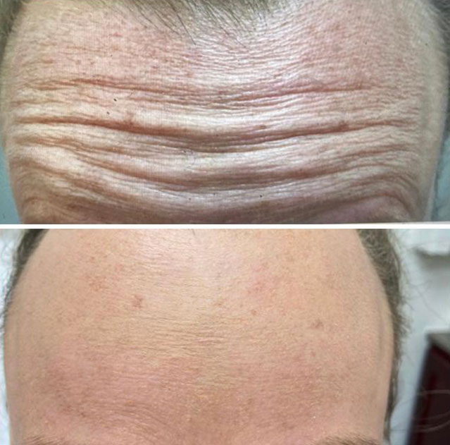 A photo of a forehead prior to and after botox injections.