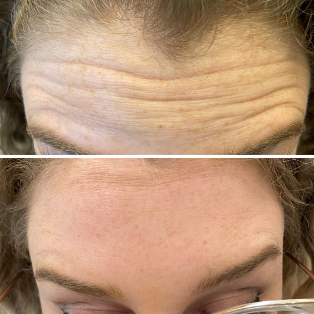 A photo of a forehead prior to and after botox injections.