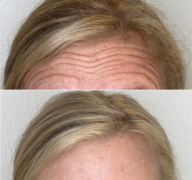 A photo of a forehead prior to and after botox injections.