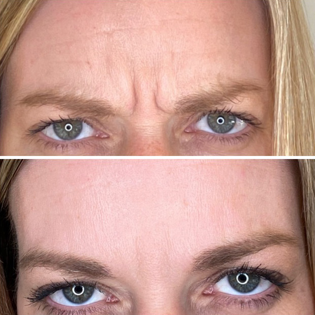 A photo of a forehead prior to and after botox injections.
