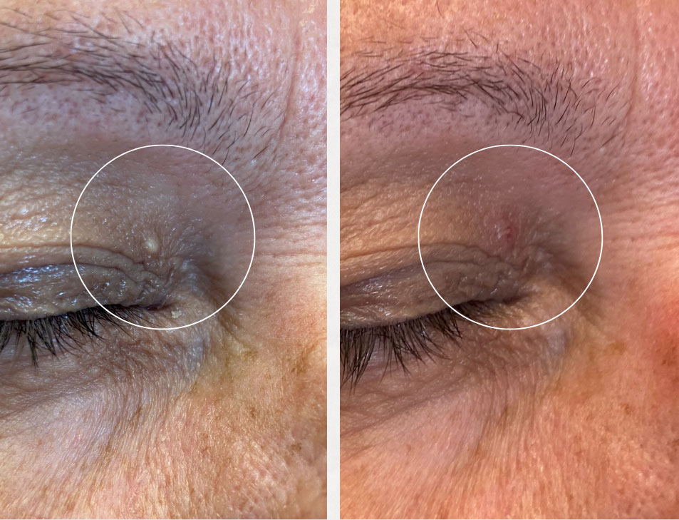 Before and after cyst removal Photos of before and after cyst removal by Dr. Rice