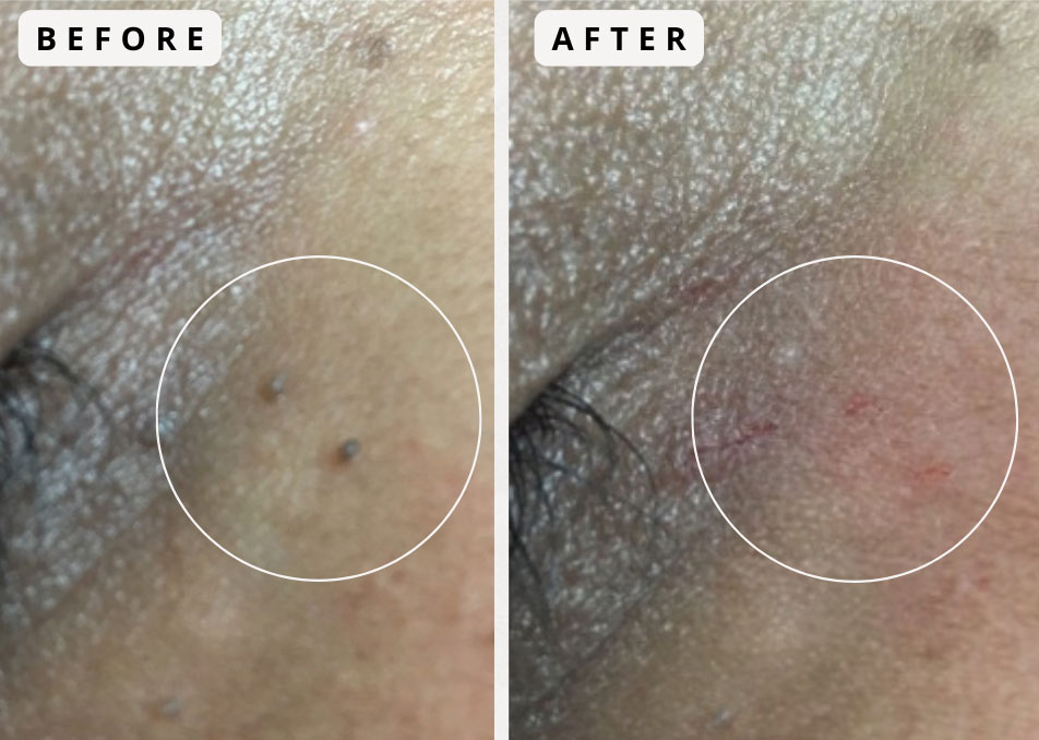 Before and after a skin lesion removal Photos of before and after a skin lesion removal by Dr. Rice